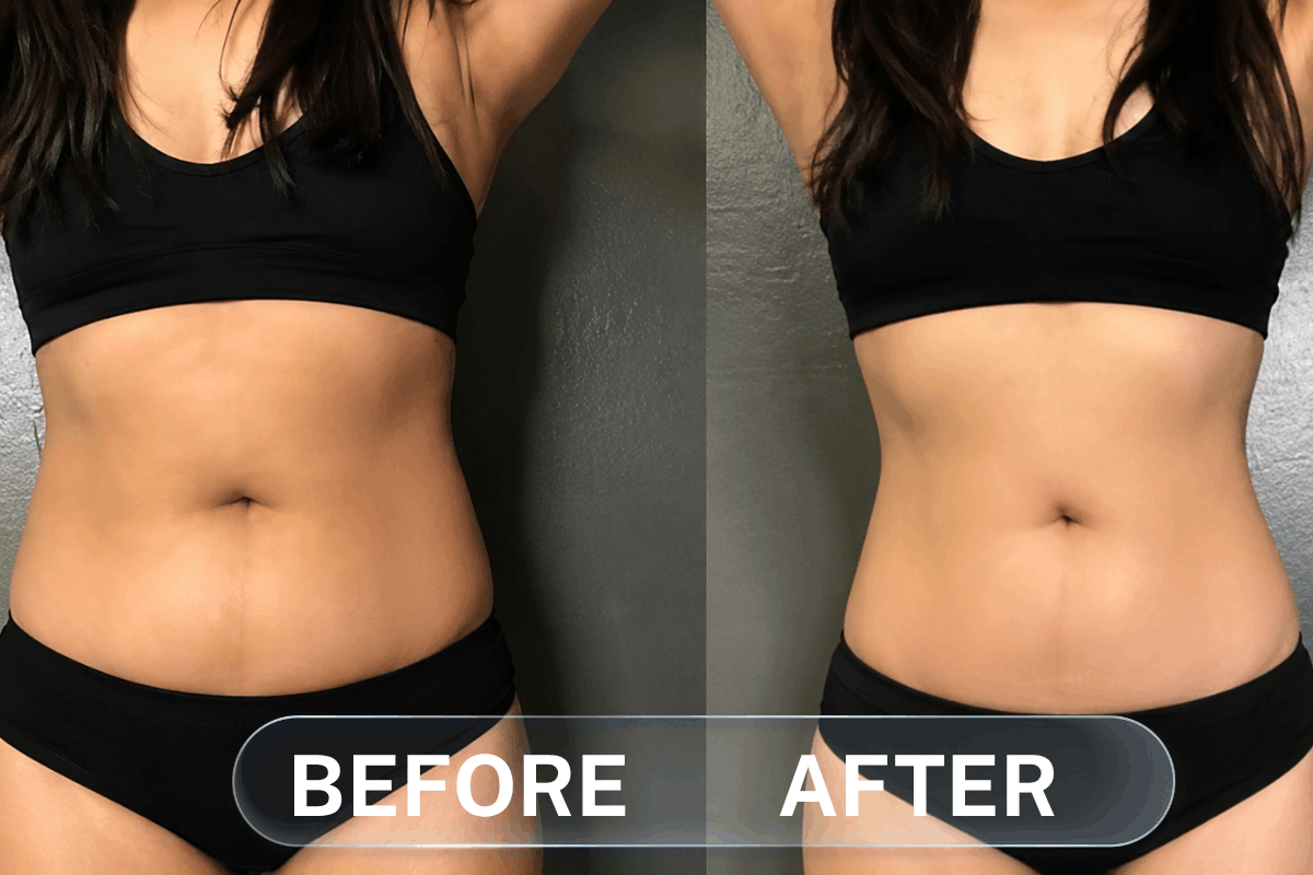 SubZero Cryotherapy Body Contouring Results – Rockville MD