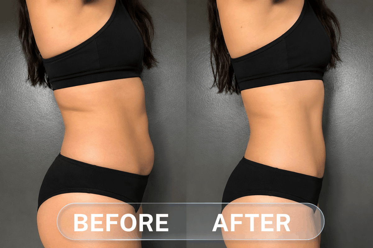 Cryotherapy Body Sculpting Before and After – Side View